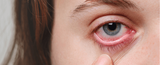 Can you spot the allergy eye?