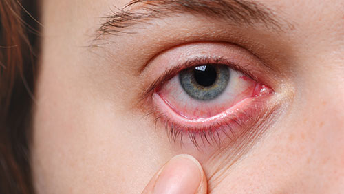 Can you spot the allergy eye?